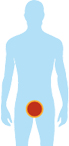 Prostate cancer that has not spread; Icon